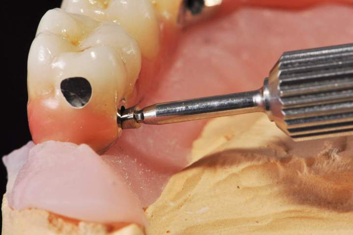 Dental Implants Melbourne