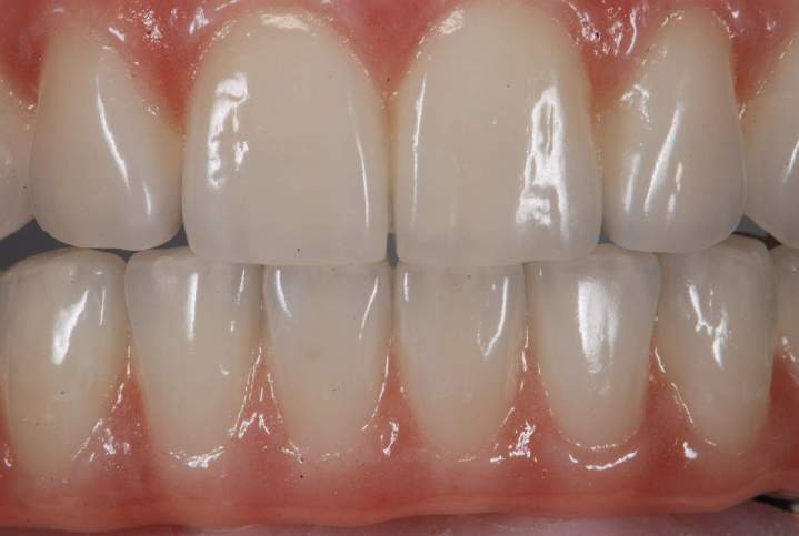 Dental Restorations Melbourne